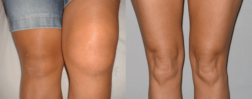 Erfarung mat Cannabis Oil Kapselen virun an nom Gebrauch vun Eva